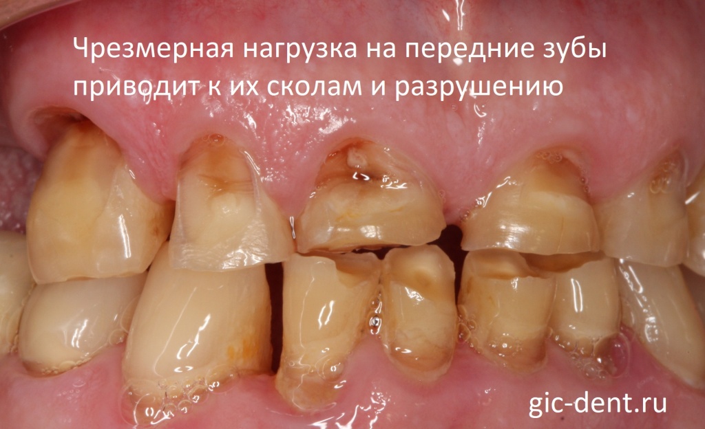 Разрушение передних зубов в случае их перегрузки происходит изо дня в день. Сначала это незаметно, потом уже очень неэстетично